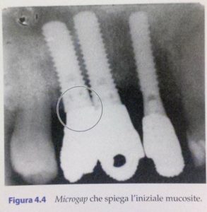 Rigenerazione dei tessuti molli: microgap che spiega l'iniziale mucosite <br> ©edi-ermes 2013