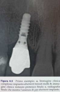 Rigenerazione dei tessuti molli: radiografia finale che mostra l'assenza di gap abutment-impianto <br> ©edi-ermes 2013
