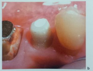 Rigenerazione dei tessuti molli: Immagini cliniche complesso impianto-abutment-tessuti molli <br> ©edi-ermes 2013