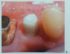 Rigenerazione dei tessuti molli: Immagini cliniche complesso impianto-abutment-tessuti molli ©edi-ermes 2013