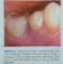 Rigenerazione dei tessuti molli: Immagini cliniche complesso impianto-abutment-tessuti molli ©edi-ermes 2013